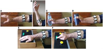 Quantitative Assessment of the Arm/Hand Movements in Parkinson’s Disease Using a Wireless Armband Device